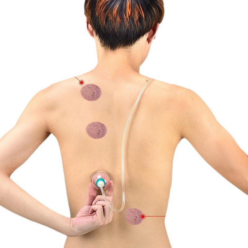 🔥Hot Sale - 49% OFF🔥Thickened Vacuum Cupping Set with Suction Pump